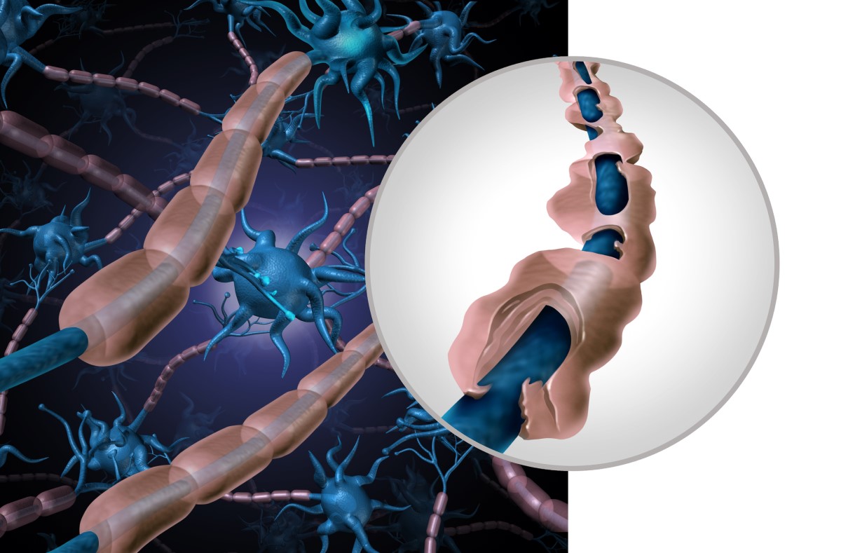 Représentation anatomique et picturale d'un neurone sain et d'un neurone endommagé - fibre démyélinisée