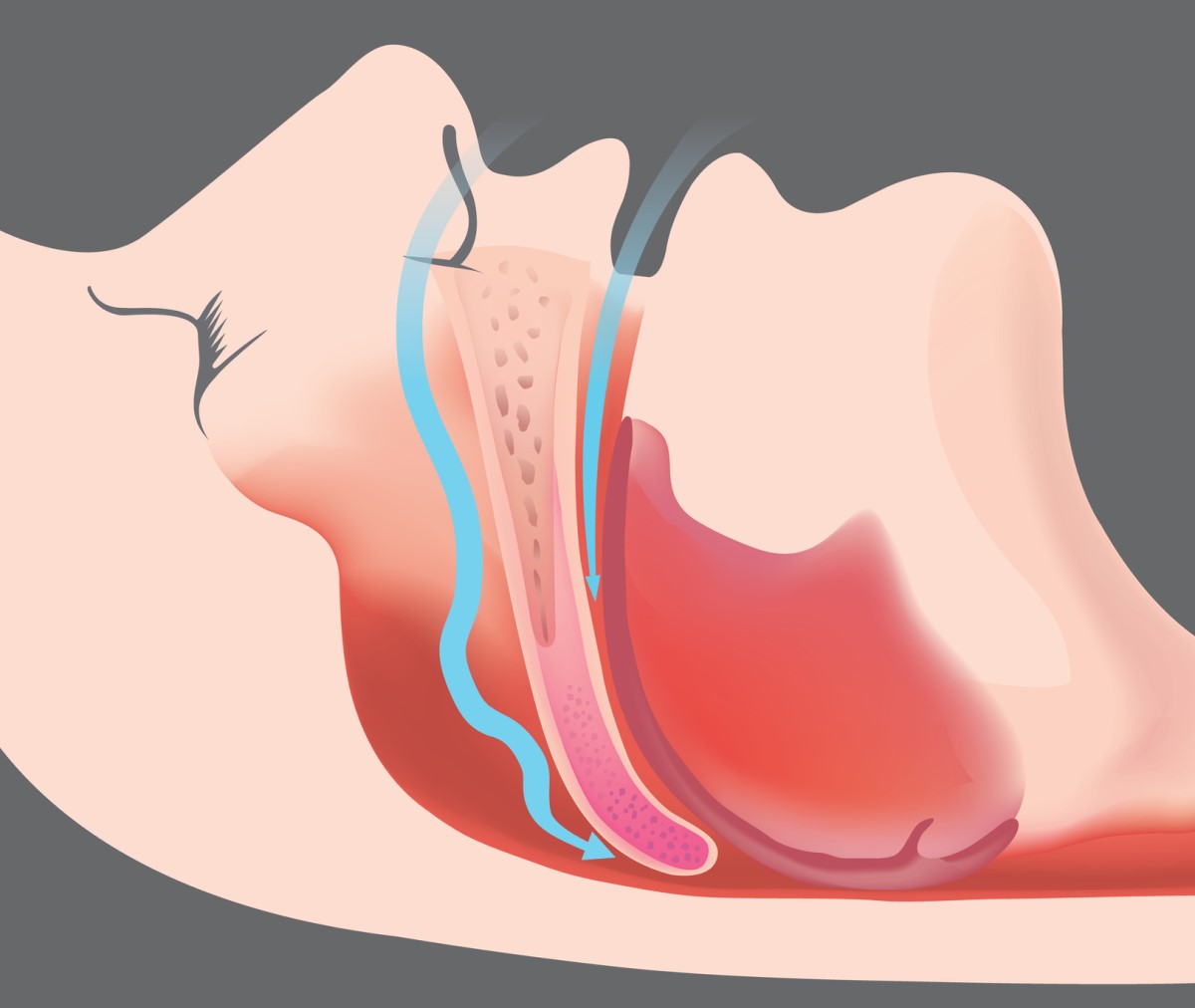 Apnée obstructive et obstruction des voies respiratoires - image animée et modèle de voies respiratoires