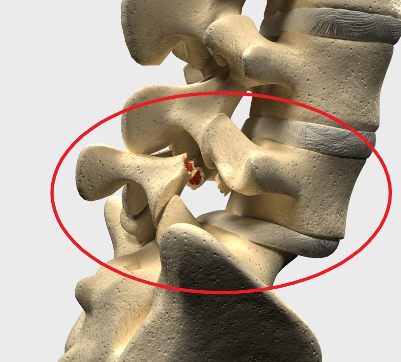 Spondylolisthésis dans la région lombaire L5 et S1 - modèle de squelette vertébral