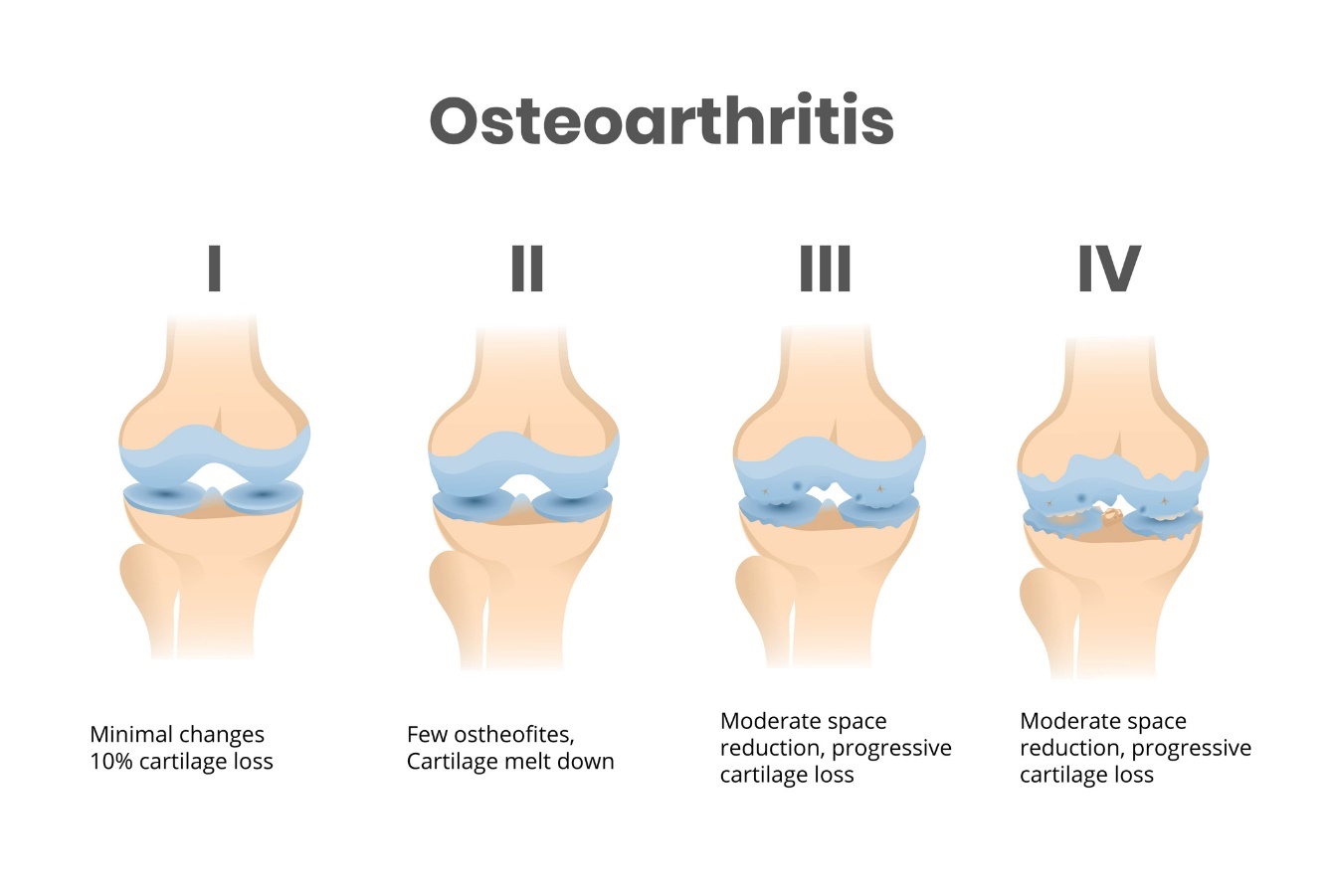 Les 4 stades de l'arthrose