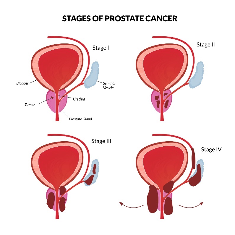 Les 4 stades fondamentaux du cancer de la prostate