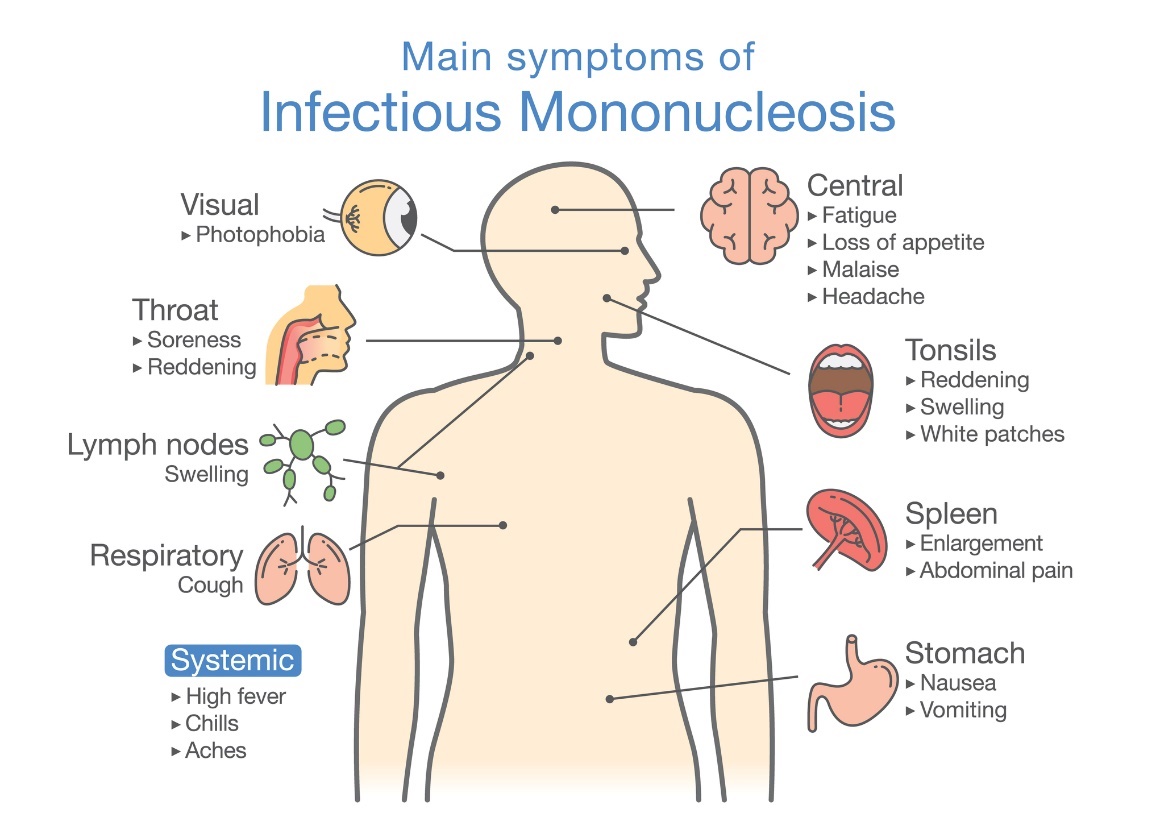 Symptômes de la mononucléose infectieuse