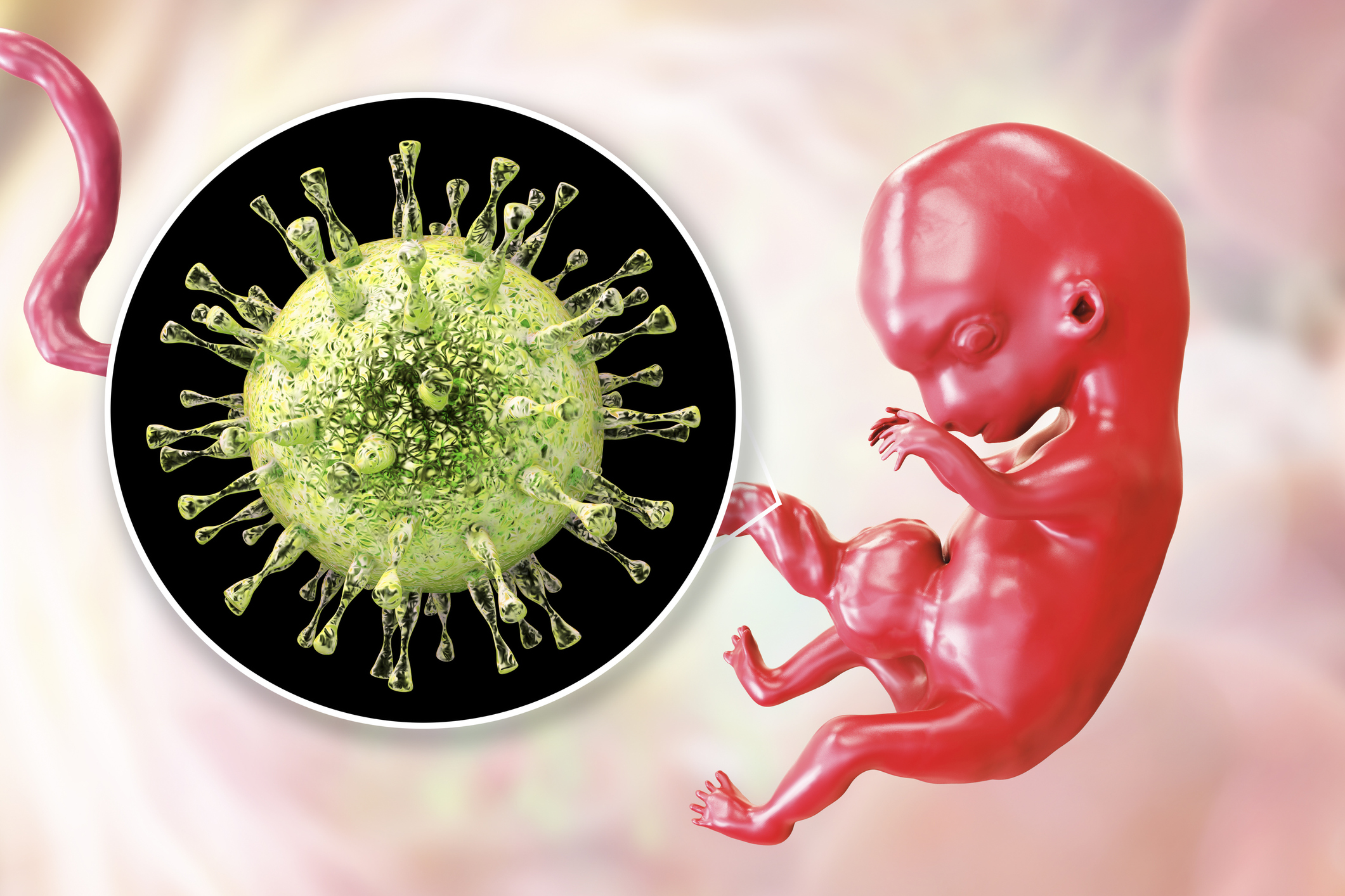 Transmission transplacentaire du cytomégalovirus