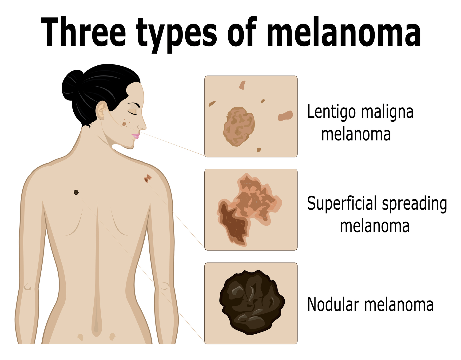 Imagerie des trois types de mélanome