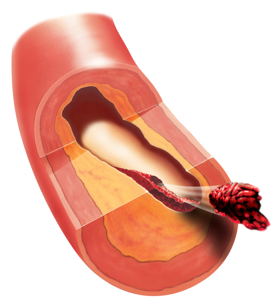 Thrombose dans un vaisseau sanguin, libération de thrombus, embolie, embolie par un caillot sanguin