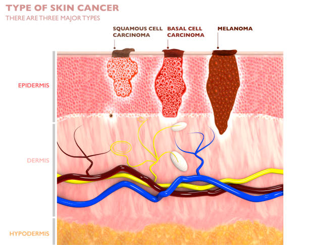 Types de tumeurs cutanées, leur pénétration dans la peau - carcinome épidermoïde, basaliome et mélanome