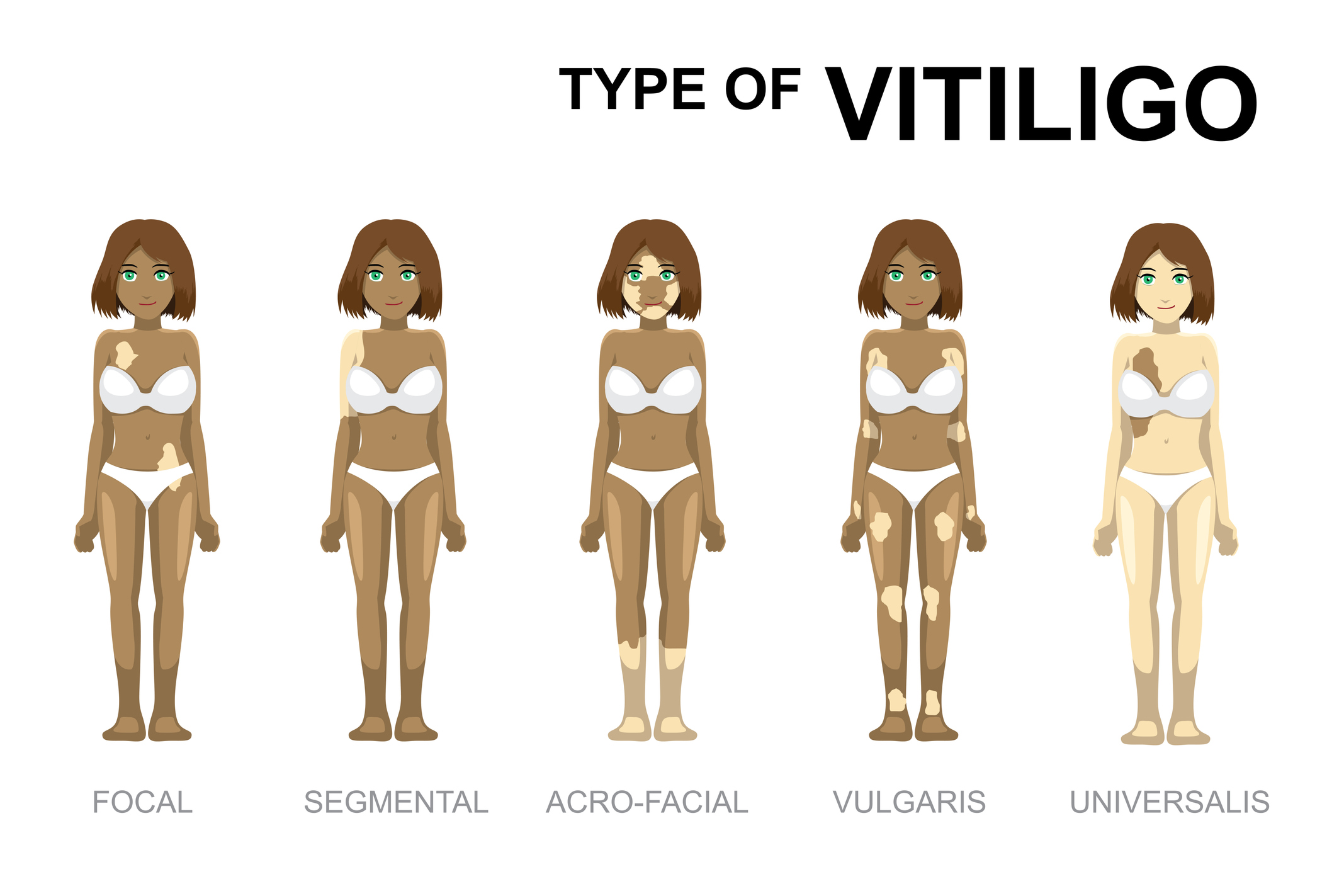 Types de vitiligo