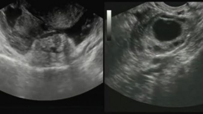 USG - sonographie de l'abdomen - image pendant l'examen, imagerie de l'utérus et de la grossesse extra-utérine.