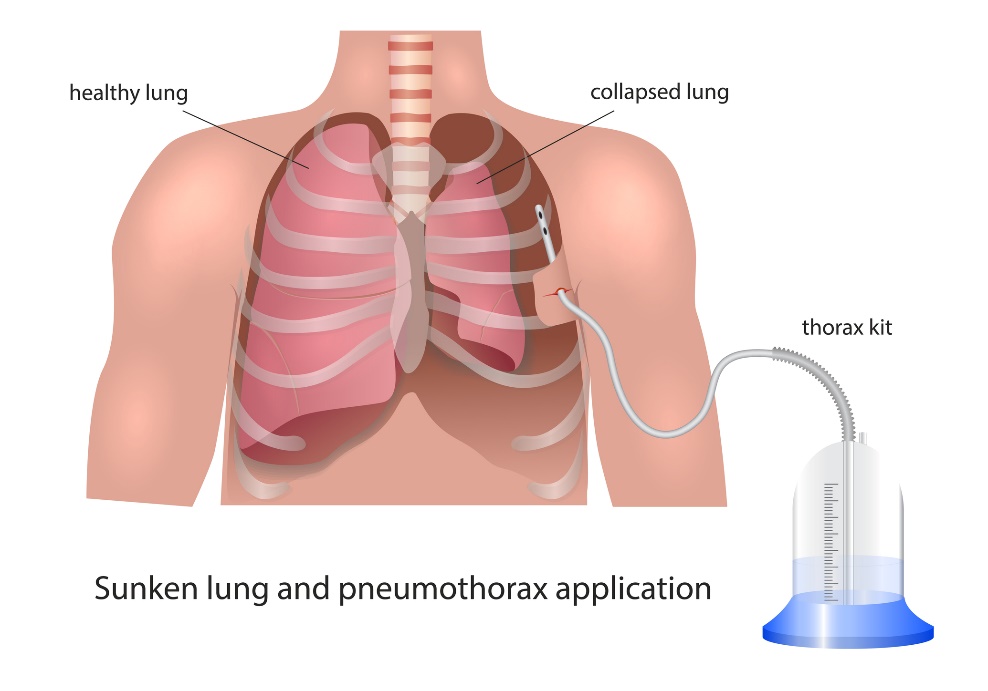 Visualisation du drainage pleural en cas de pneumothorax : poumon sain, poumon effondré et dispositif de drainage