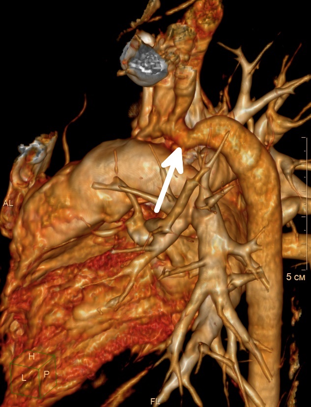 Visualisation de la coarctation (rétrécissement) de l'aorte dans la partie descendante du vaisseau cardiaque.