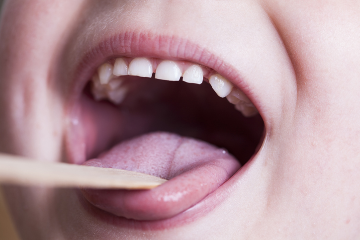 Examen de la gorge à l'aide d'un bâton buccal en bois - enfant