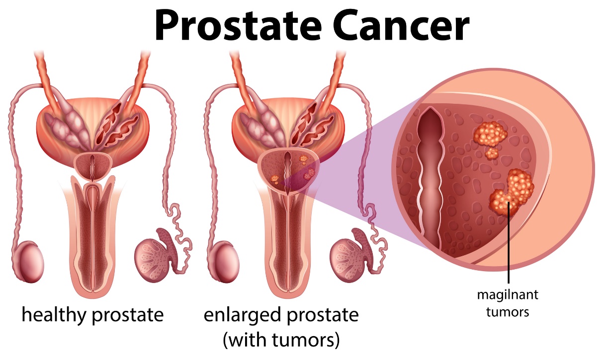 Cancer de la prostate : prostate saine et prostate hypertrophiée avec tumeur