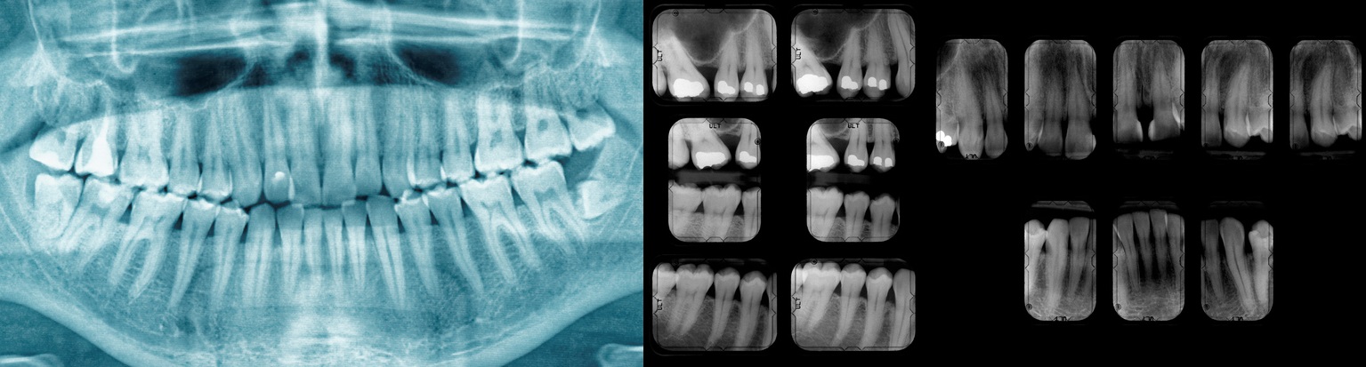 Radiographie dentaire pour montrer l'état des dents, les caries et les obturations.