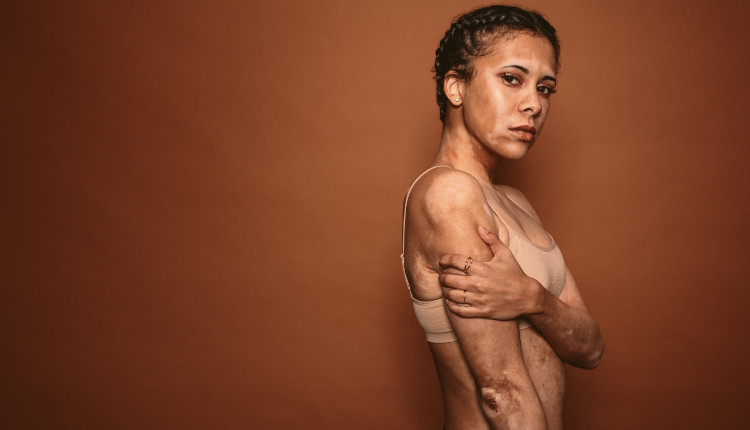 Femme présentant des taches blanches sur le corps - vitiligo