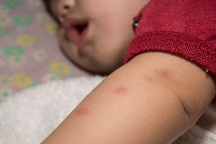 un enfant en T-shirt rouge avec une piqûre de moustique sur le bras