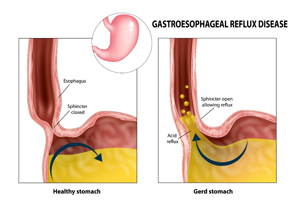 Reflux gastro-œsophagien : œsophage, sphincter, estomac et acide gastrique