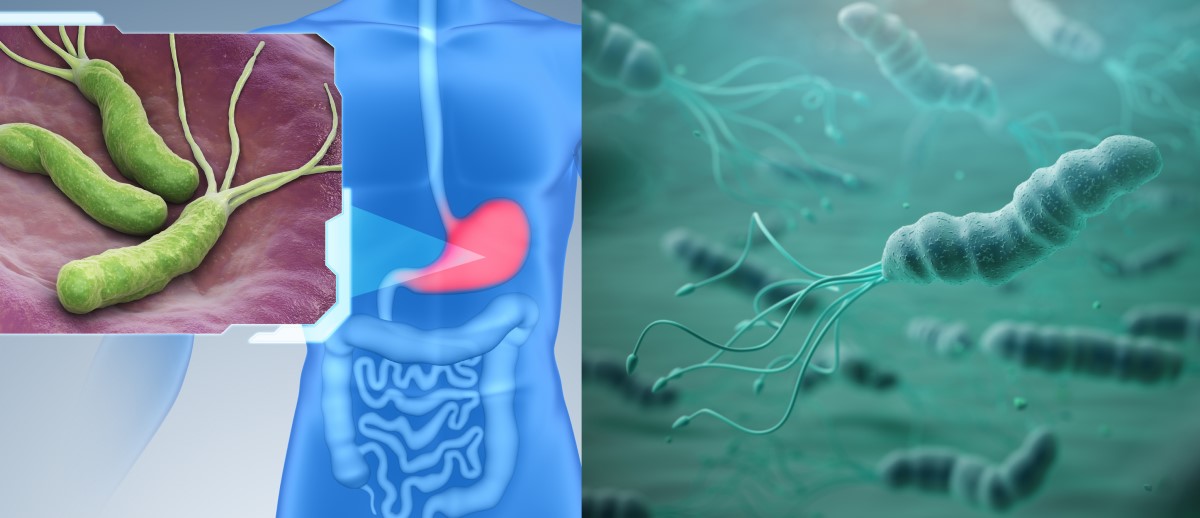 Helicobacter pylori colonise la paroi de l'estomac et constitue un facteur de risque de gastrite, d'ulcère et de cancer.