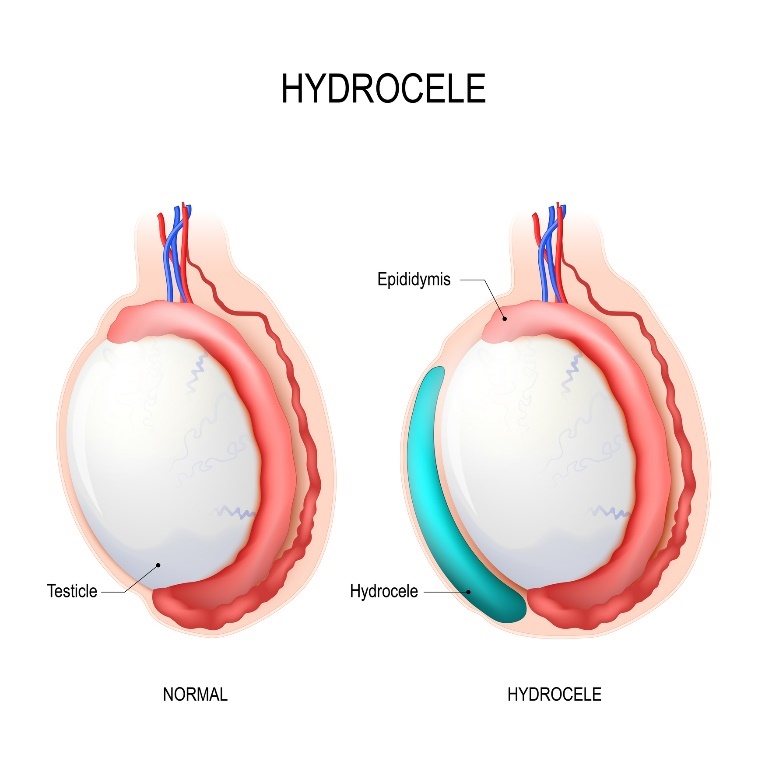 Hydrocèle : testicule, Épididyme (épididyme), Hydrocèle (accumulation de liquide)