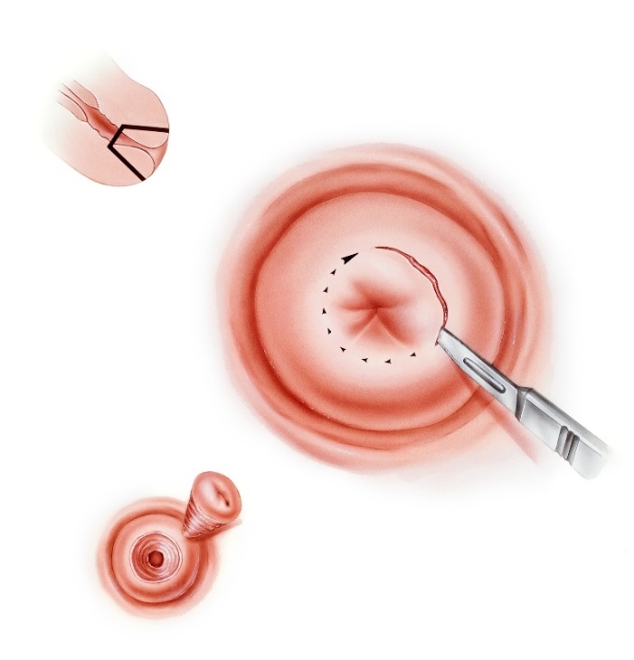 Conisation cervicale au scalpel