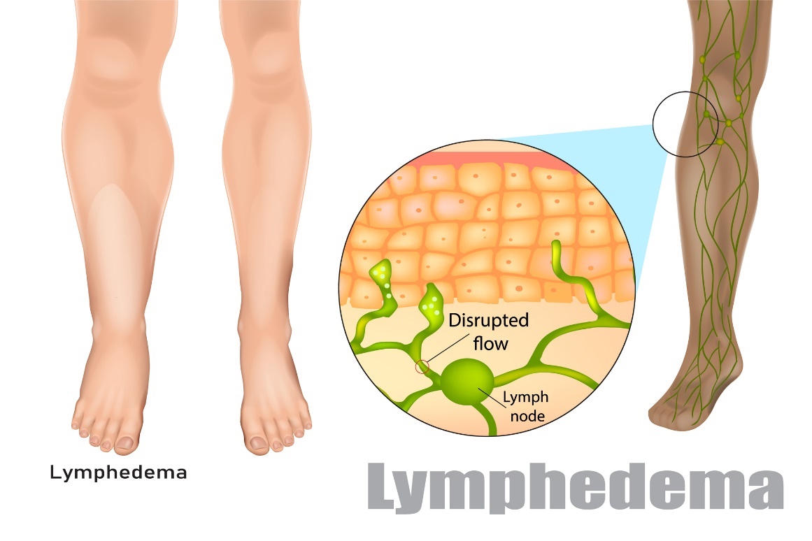 Lymphoedème