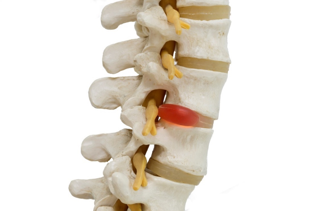 Représentation anatomique d'un modèle 3D de la colonne vertébrale, des disques intervertébraux et de la hernie discale avec compression nerveuse