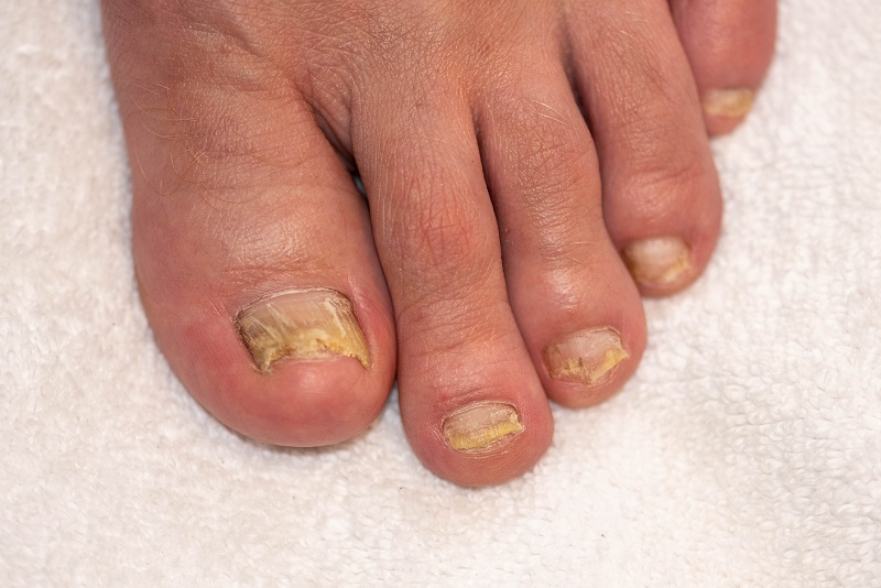 Infection mycosique des ongles de pied