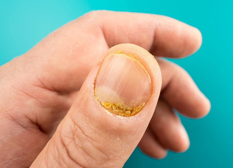 Un ongle de pouce présentant des signes de psoriasis.