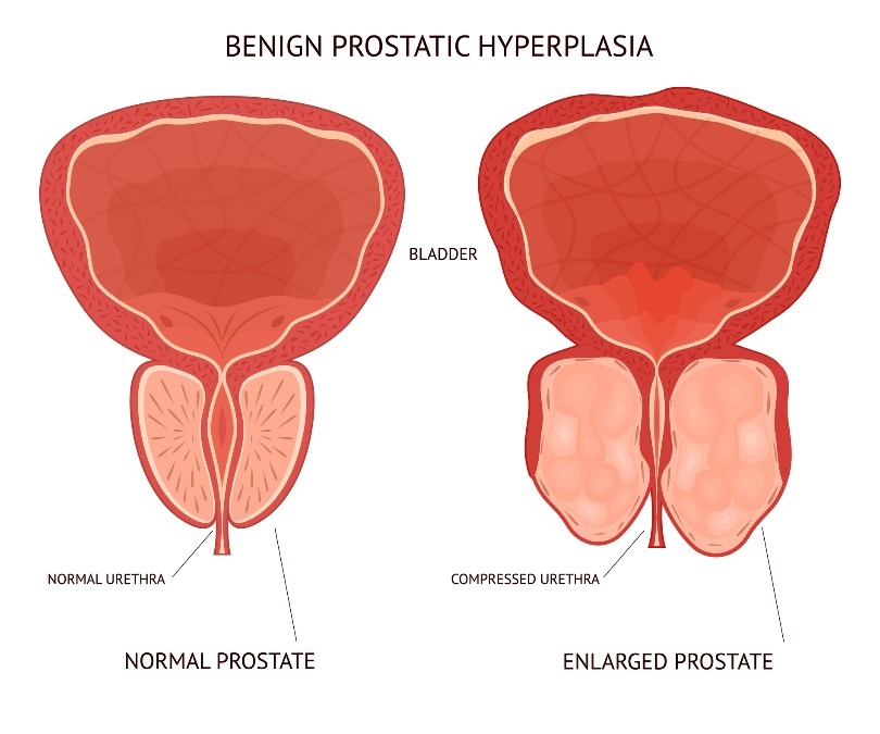 Vessie (bladder), tissu physiologique et hypertrophié de l'organe de la prostate.