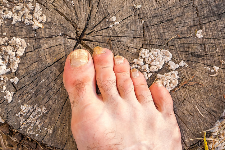 un pied avec des champignons sur les ongles, couché sur une souche d'arbre