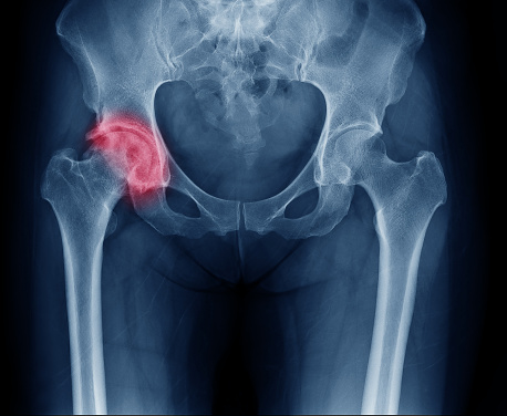 Radiographie du bassin, articulation de la hanche droite atteinte d'arthrose