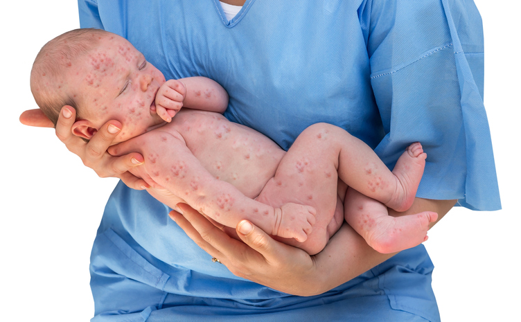 un enfant atteint de germes cutanés sur les mains d'un médecin