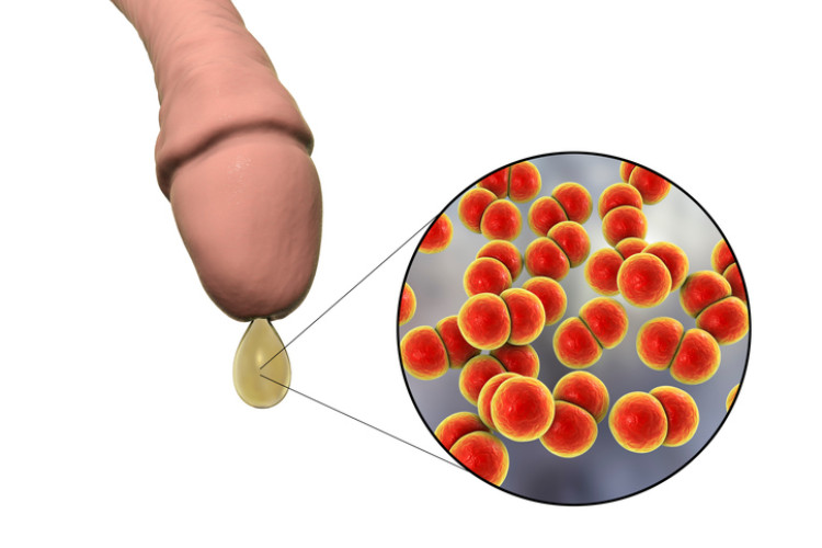 Amphysème du pénis avec écoulement et bactéries microscopiques de la gonorrhée