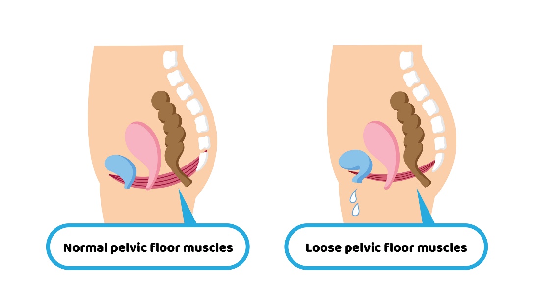 État physiologique de la musculature du plancher pelvien et état permissif de la musculature du plancher pelvien entraînant l'incontinence