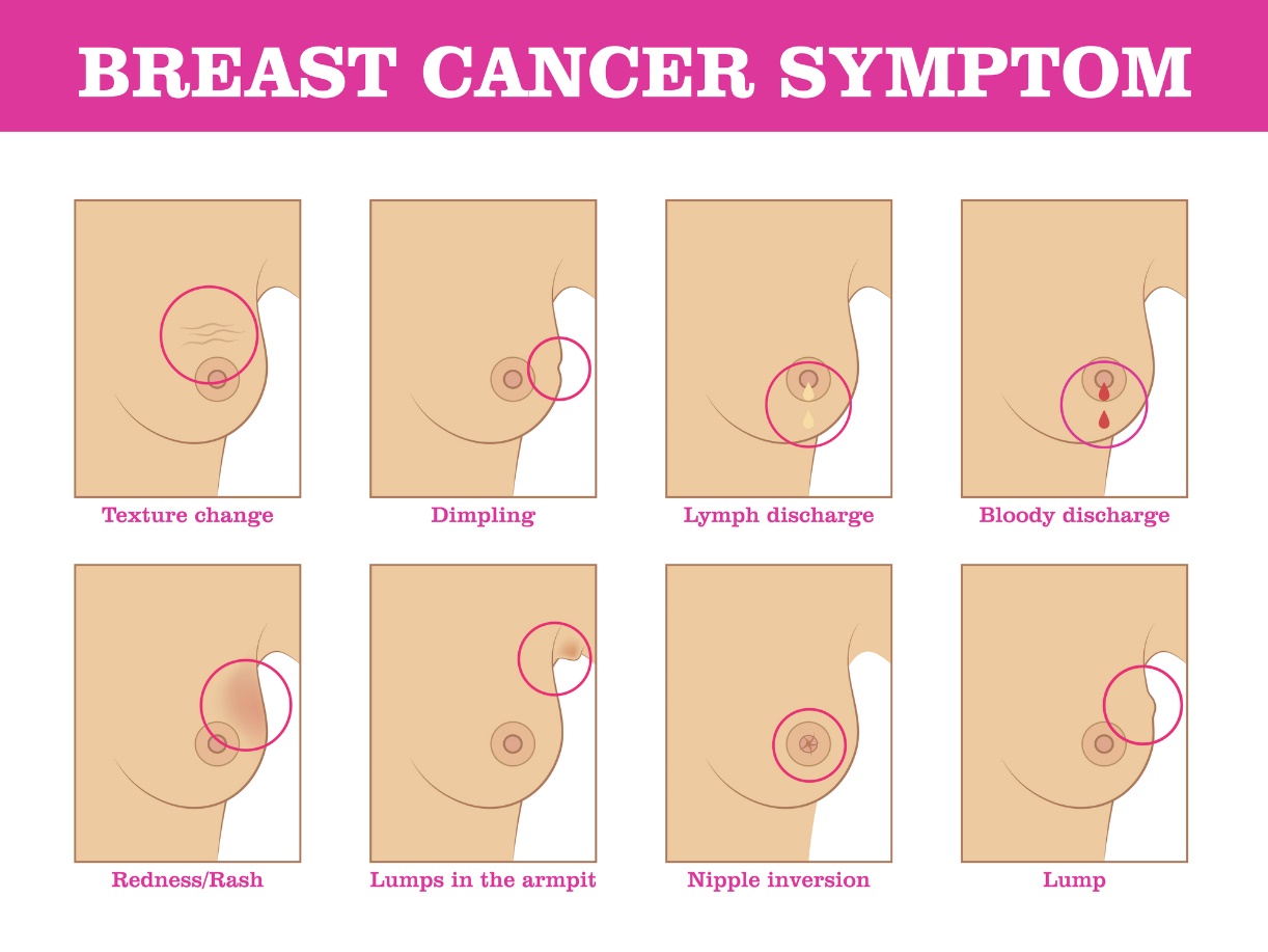 Symptômes du cancer du sein : modification de la structure du sein, modification de la couleur et de la surface du sein, écoulement et rétraction du mamelon, localisation de la masse.