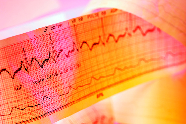 Enregistrement ECG