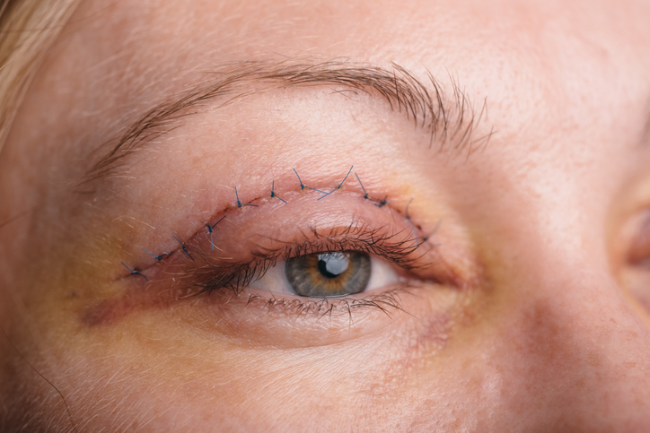 Femme, visage et paupière après blépharoplastie - blépharoplastie