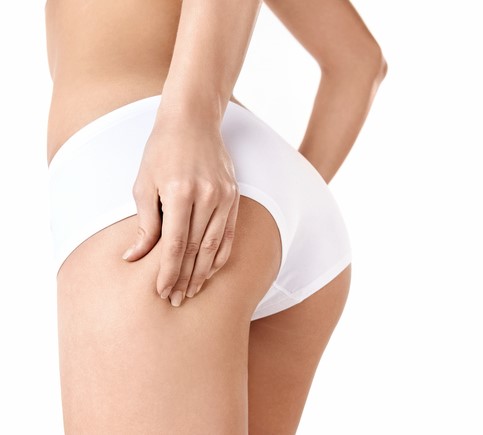 Une femme effectue un test de pincement pour vérifier si elle souffre de cellulite, sur sa cuisse et ses fesses.