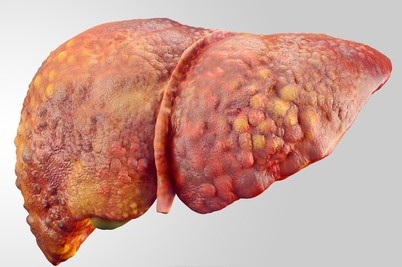 Foie endommagé par une cirrhose, altération de la fonction hépatique, urine foncée en conséquence