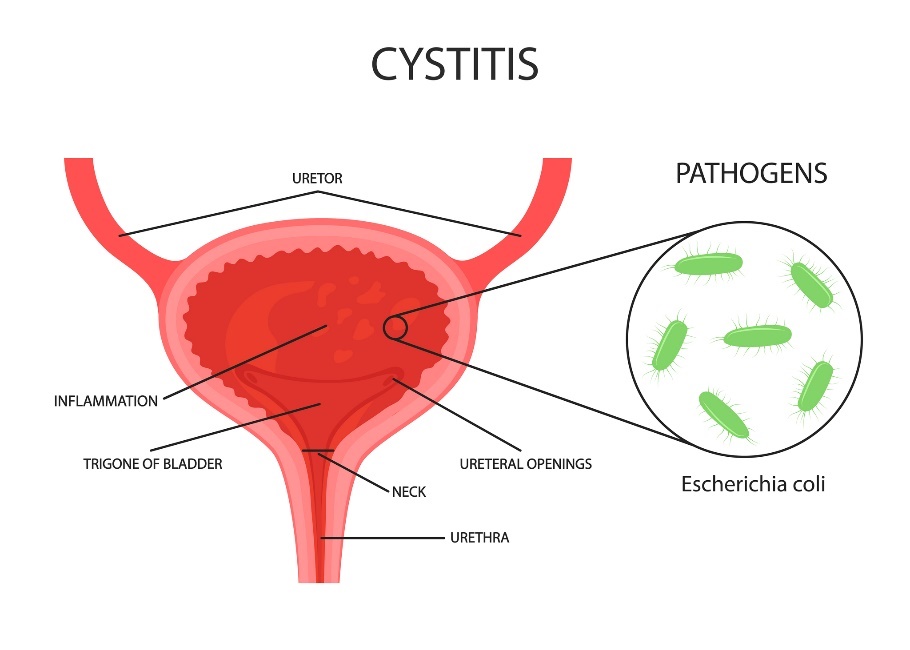 Inflammation de la vessie