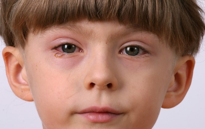 L'enfant présente une inflammation des yeux, une conjonctivite, c'est-à-dire une inflammation de la conjonctive.