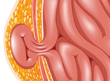 La hernie, la complication la plus fréquente de l'ascite