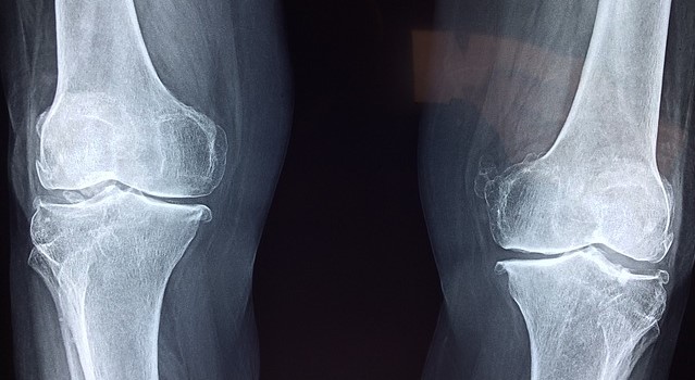 Radiographie des articulations du genou