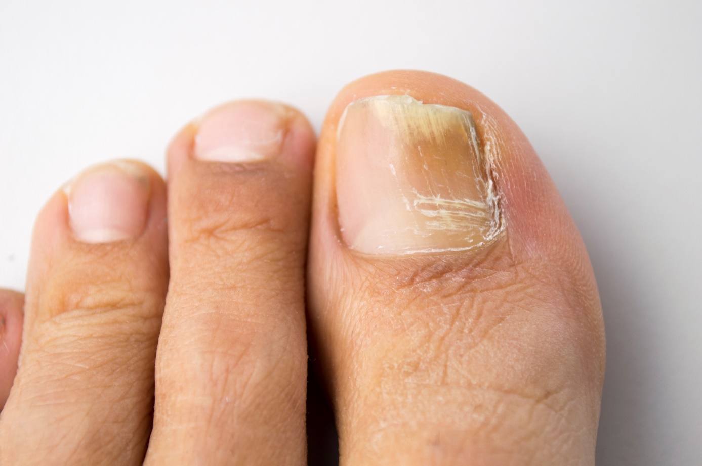 Ongles cassants et fragilité visible des ongles des membres inférieurs, des pieds.