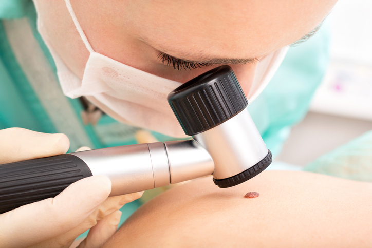 le médecin examine le grain de beauté à l'aide d'un dermatoscope