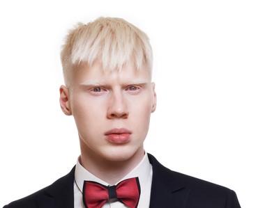 jeune homme albinos, cheveux blancs, portant une veste