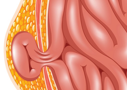 Modèle de hernie, c'est-à-dire hernie de la paroi abdominale