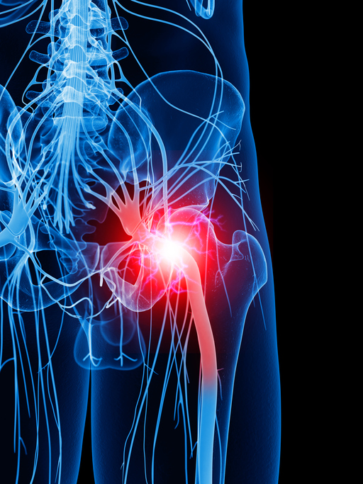 Modèle du nerf de la fesse, c'est-à-dire le nerf sciatique, et douleur dans la région, c'est-à-dire sciatique, irradiation de la douleur vers le membre inférieur.