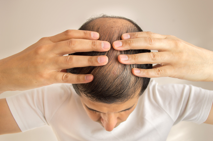 Homme aux cheveux clairsemés, perte de cheveux, calvitie ou alopécie, mains sur la tête, vue de dessus