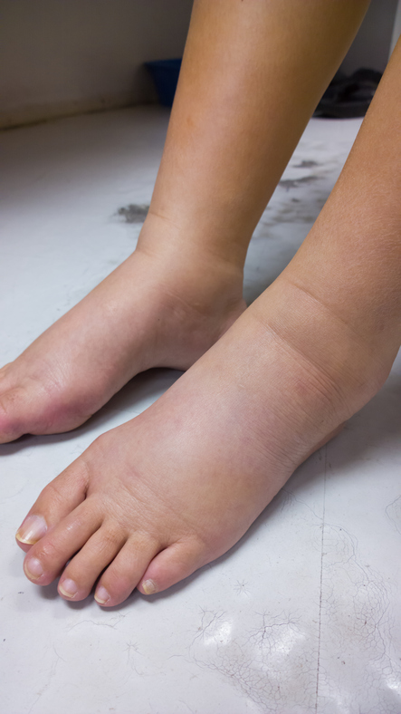 Gonflement de la partie inférieure des jambes, des tibias et des chevilles, gonflement des orteils