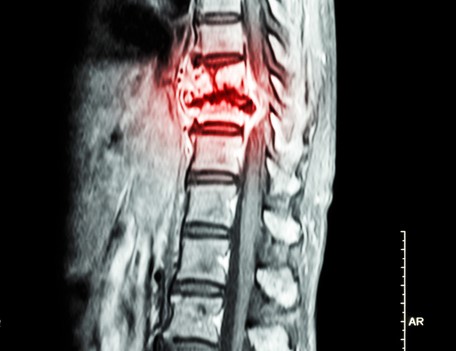 Radiographie de la colonne vertébrale thoracique mettant en évidence un cancer de la colonne vertébrale thoracique